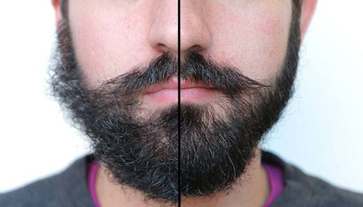 4 maneras fáciles de deshacerse de la caspa de la barba de una vez por todas